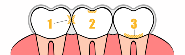 虫歯のできやすい場所TOP３