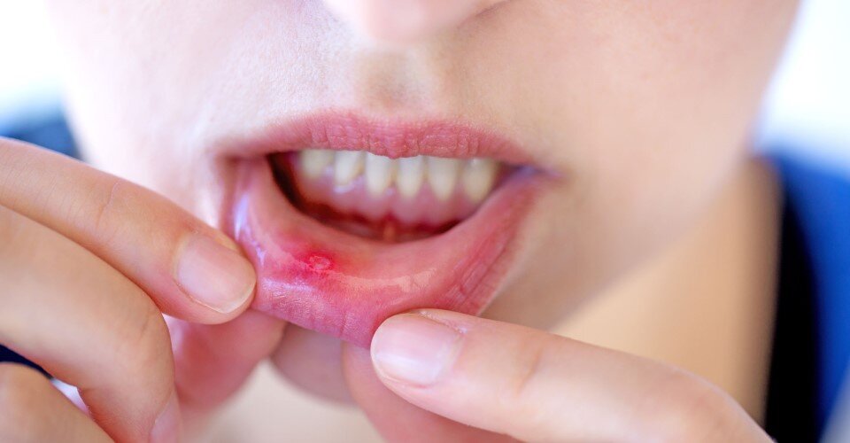 口内炎の種類とその原因は？食事や生活習慣を見直して予防しよう