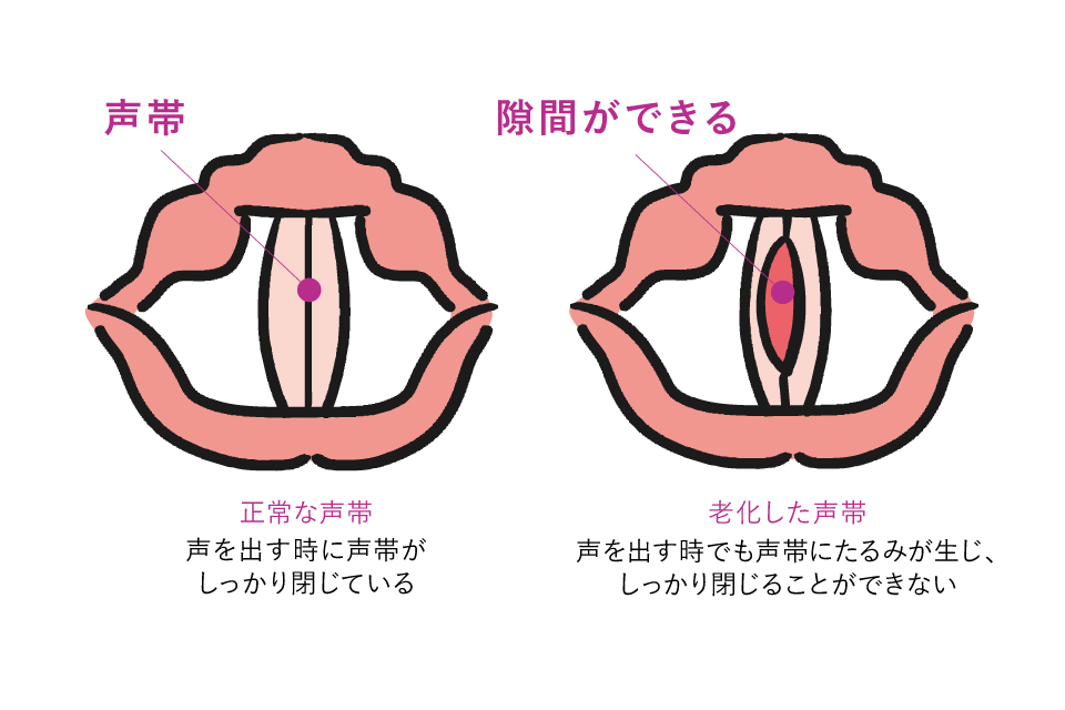 老化による声帯の変化